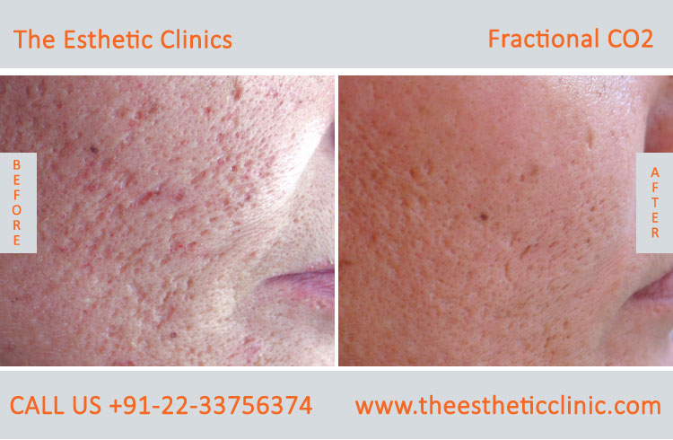 Fractional Co2 Laser Skin Resurfacing Treatment before after photos in mumbai india (2)